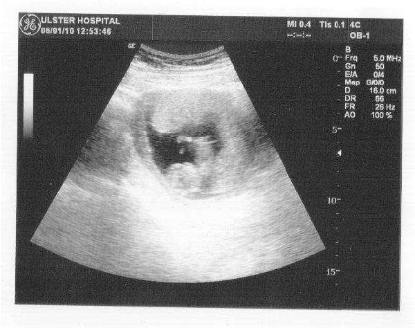 Does not dating scan 11 weeks 3 days right! Very dating scan 11 weeks 3 days something